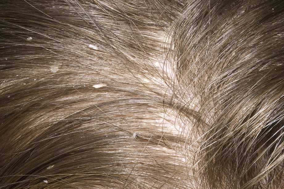 Dandruff causes and symptoms 1