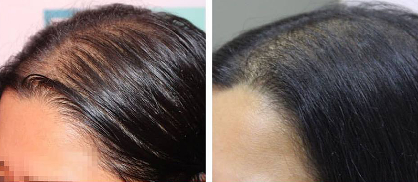 hair transplant