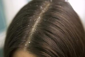 3 Types of dandruff and what to know when buying a anti-dandruff product 1