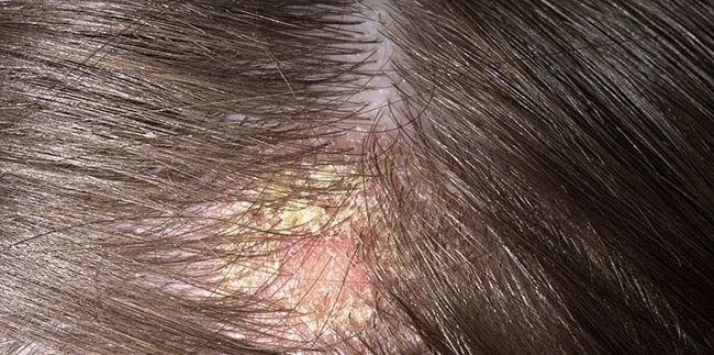 Scabs on Scalp: Everything You Need to Know - Wimpole Clinic